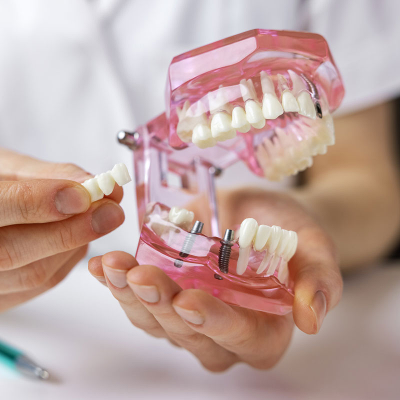 dental implants diagram
