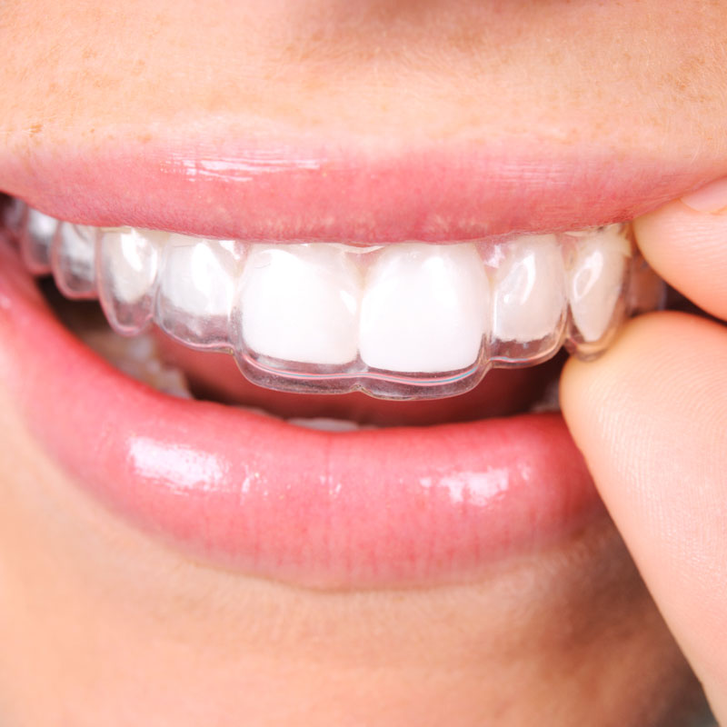 clear aligner
